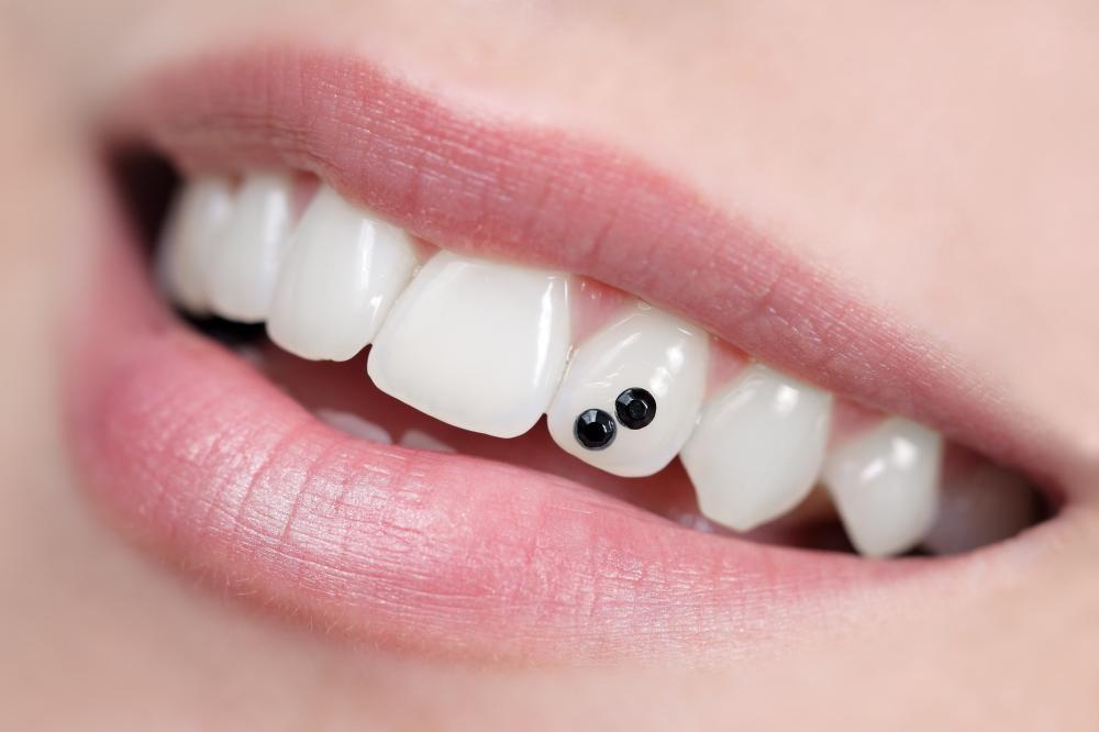 Bijoux dentaires (3)