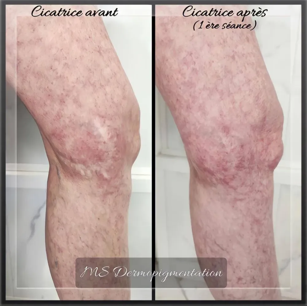 dermopigmentation (3)
