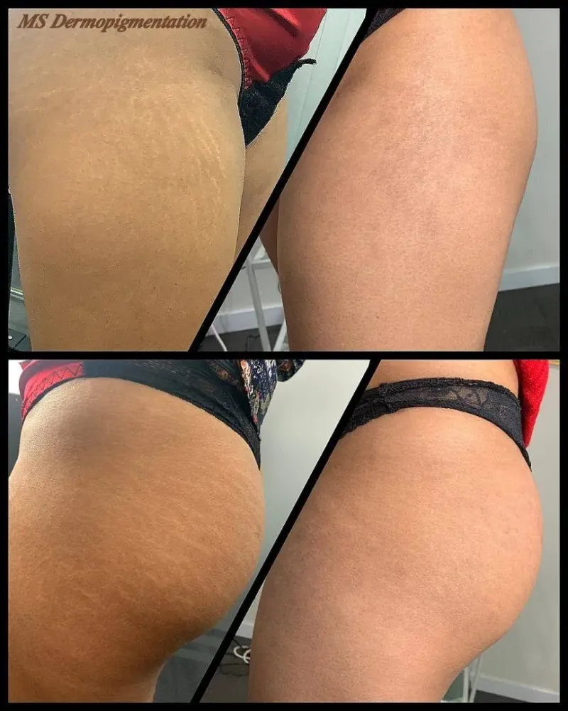 dermopigmentation (5)