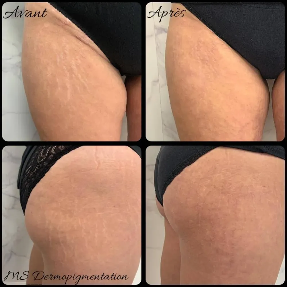 dermopigmentation (6)
