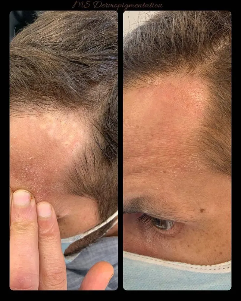 dermopigmentation (13)