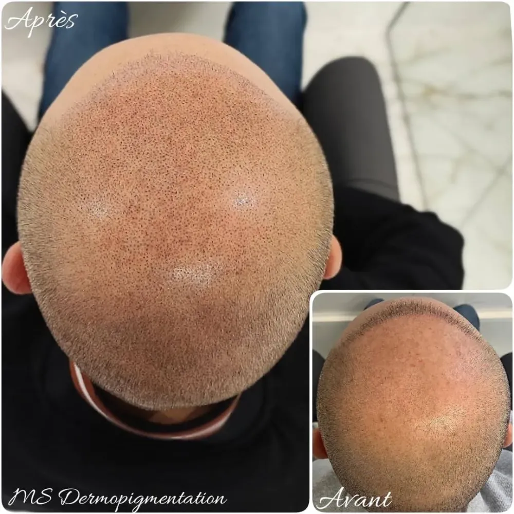 dermopigmentation (14)