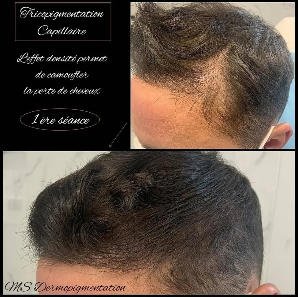 dermopigmentation (15)