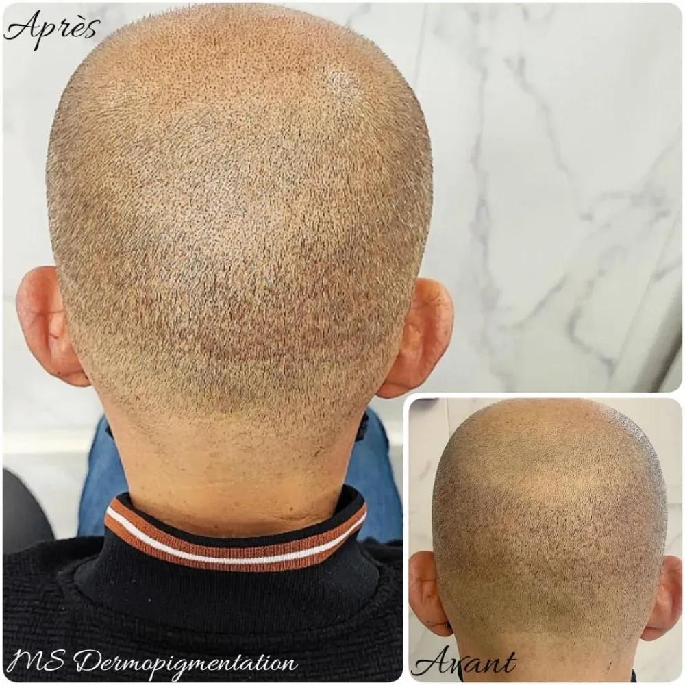 dermopigmentation (16)