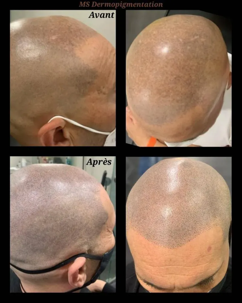 dermopigmentation (17)