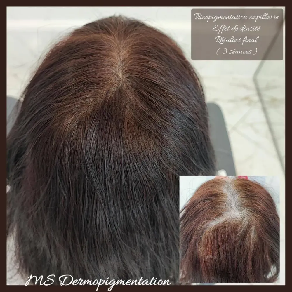 dermopigmentation (18)