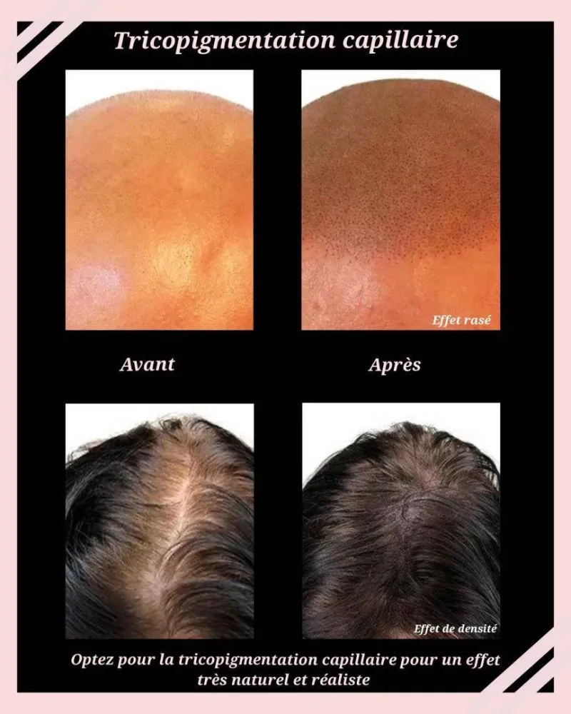 dermopigmentation (19)